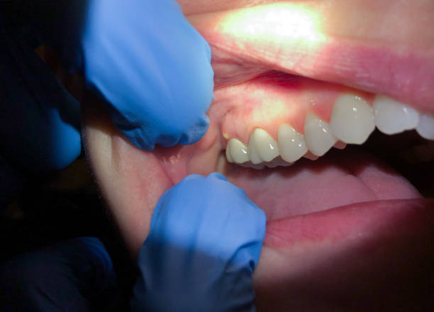 Best Emergency Tooth Extraction in New Hope, MN